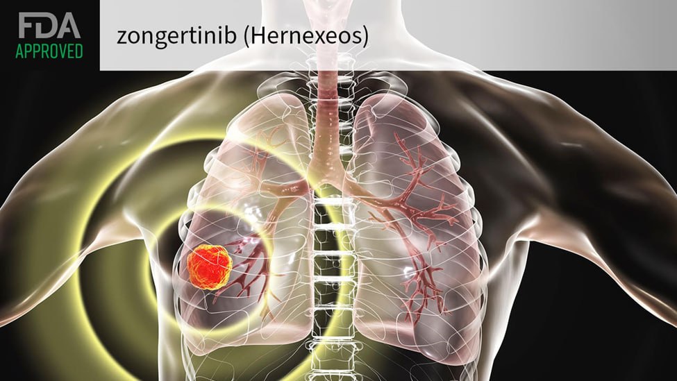 US FDA approves Boehringer Ingelheim’s lung cancer treatment