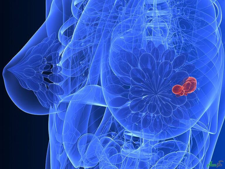 رشد ابتلا به سرطان پستان در ایران